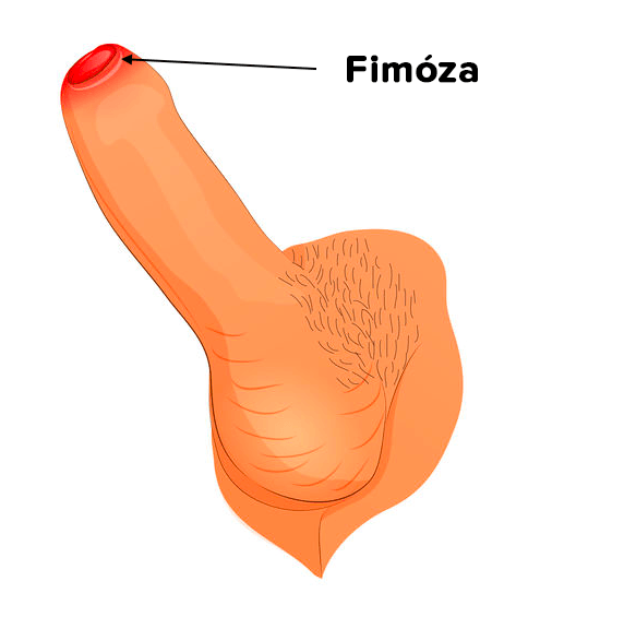 Fimóza- zúžení předkožky