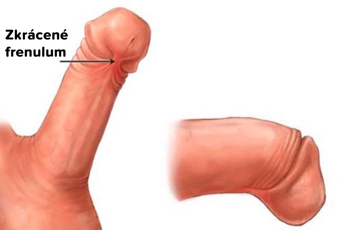 Frenuloplastika, frenulum breve, zkrácená uzdička Frenuloplastika, frenulum breve, zkrácená uzdička