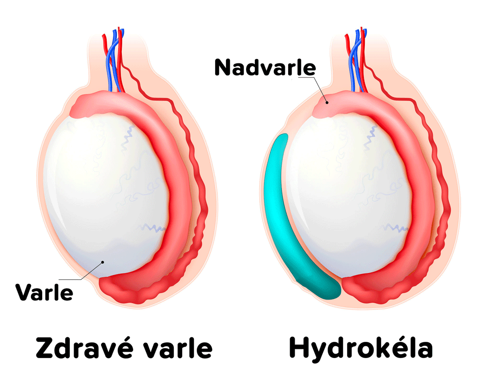 Hydrokéla, vodní kýla Hydrokéla, vodní kýla