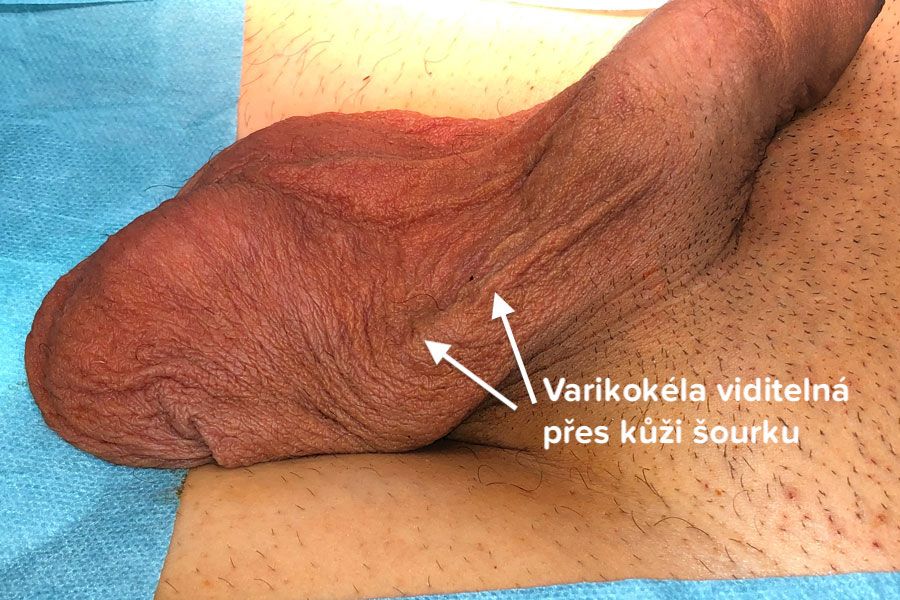 Varikokéla viditelná přes kůži