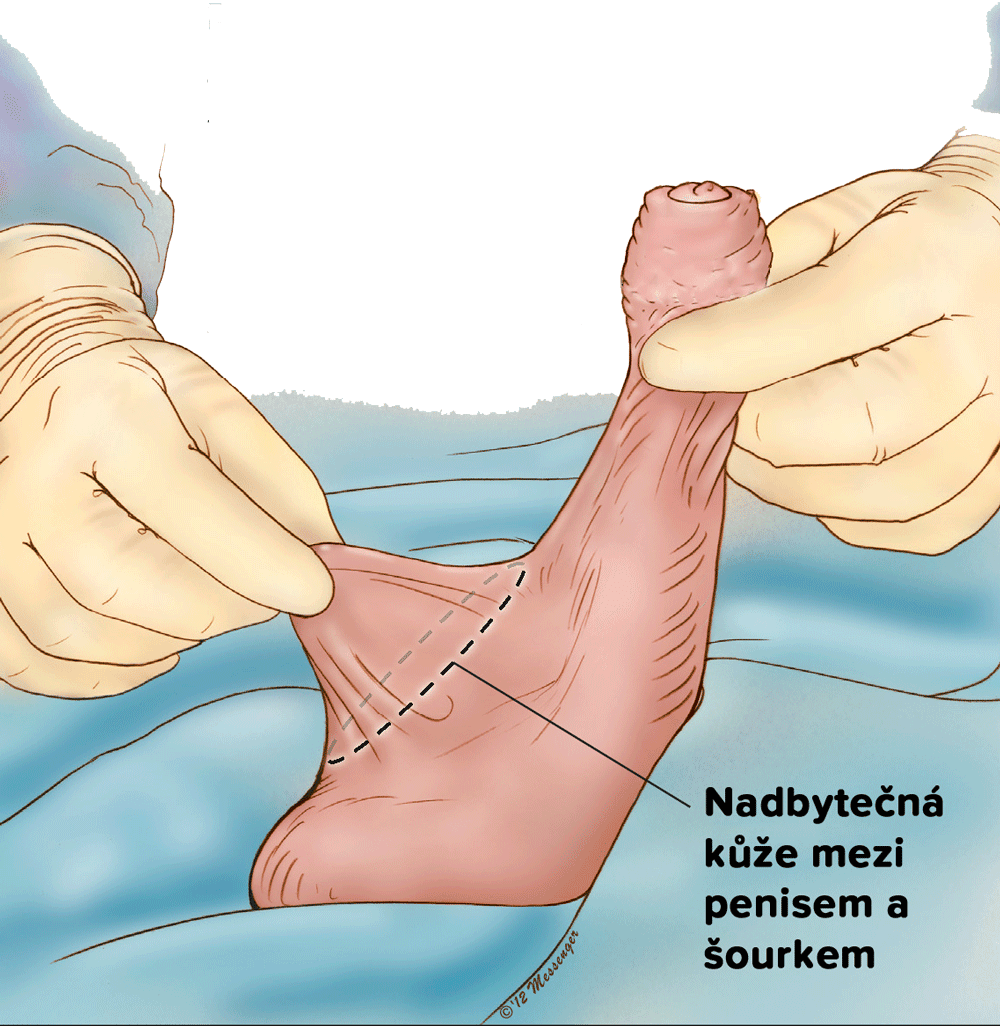 Zkrácení šourku- nadbytečná kůže mezi penisem a varlaty Zkrácení šourku- nadbytečná kůže mezi penisem a varlaty