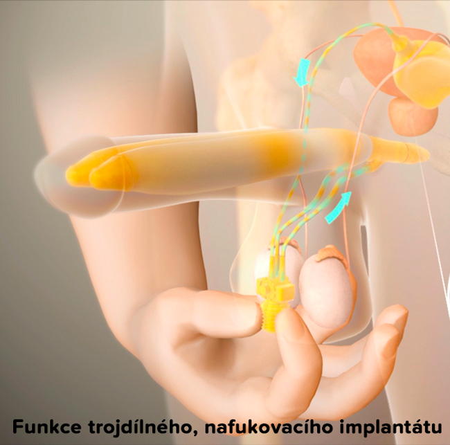 Animace vysvětlující funkci trojdílného, nafukovacího implantátu AMS