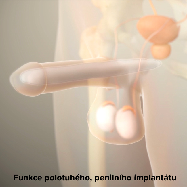 Animace vysvětlující funkci polotuhého penilního implantátu Tactra