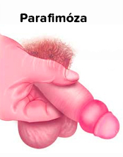 Parafimóza- zaškrcení žaludu zúženou předkožkou
