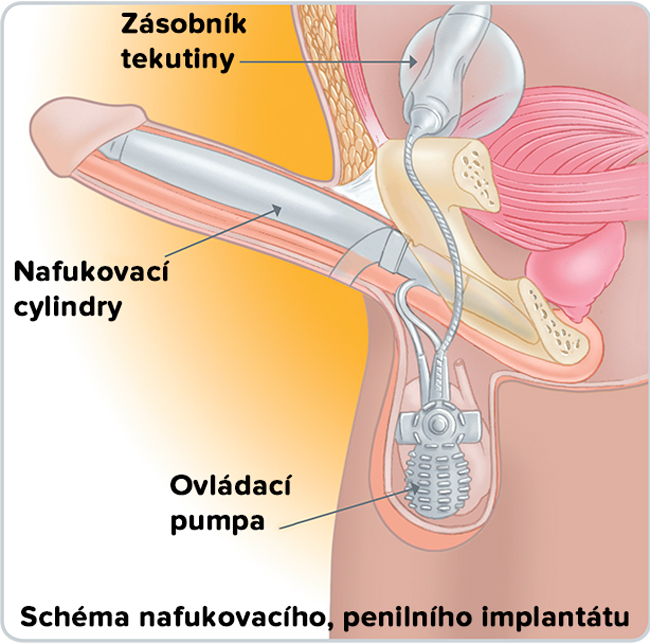 Nafukovací, penilní implantát Nafukovací, penilní implantát