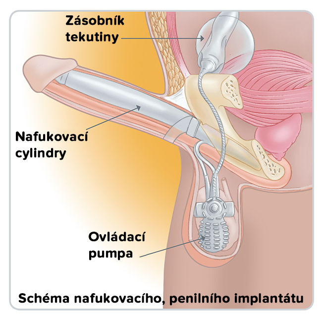 Trojdílný penilní implantát schéma