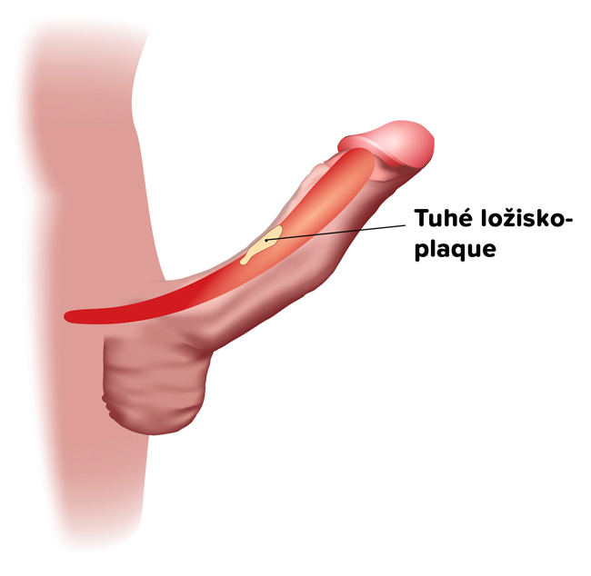 Zahnutí penisu- Peyronieho choroba