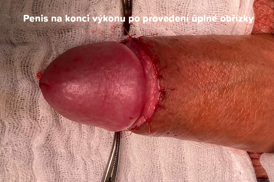 Penis ihned po klasické obžíce, před aplikací krytí na ránu