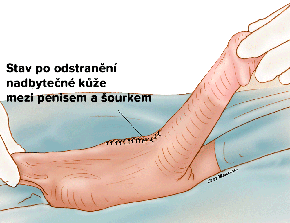 Zkrácení šourku- stav po odstranění nadbytečná kůže mezi penisem a varlaty Zkrácení šourku- stav po odstranění nadbytečná kůže mezi penisem a varlaty