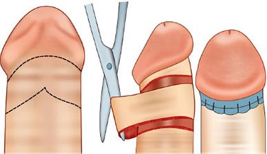 Obřízka- rukávová resekční technika