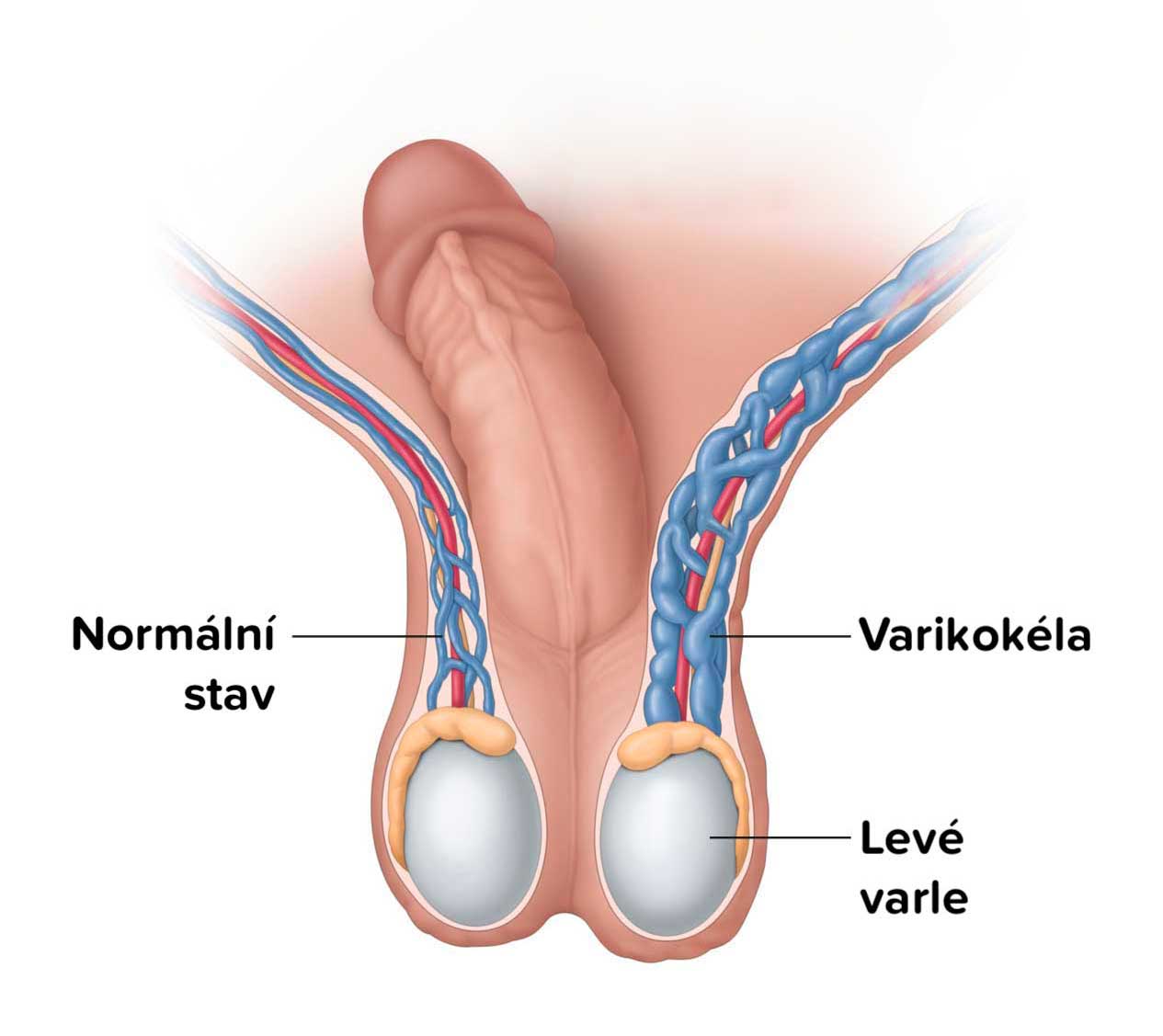 Varikokéla na levém varleti