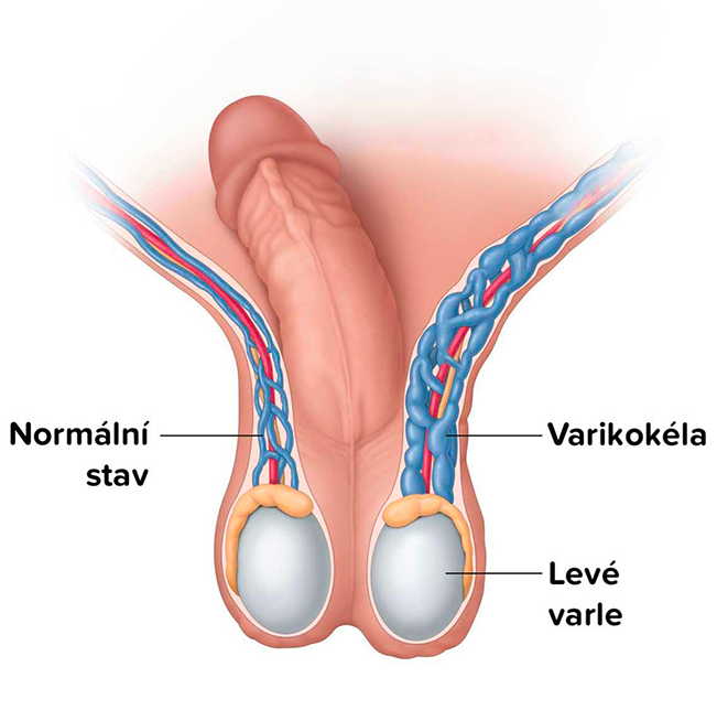 Varikokéla operace- levostranná varikokéla